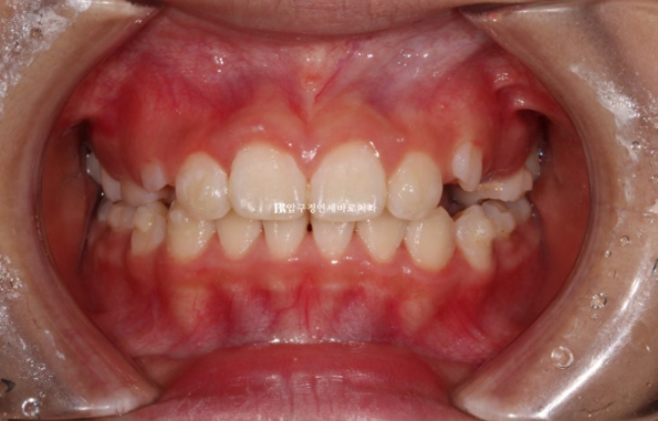 압구정 어린이교정 인비절라인 퍼스트 악궁확장 덧니 교정 관련 이미지 4