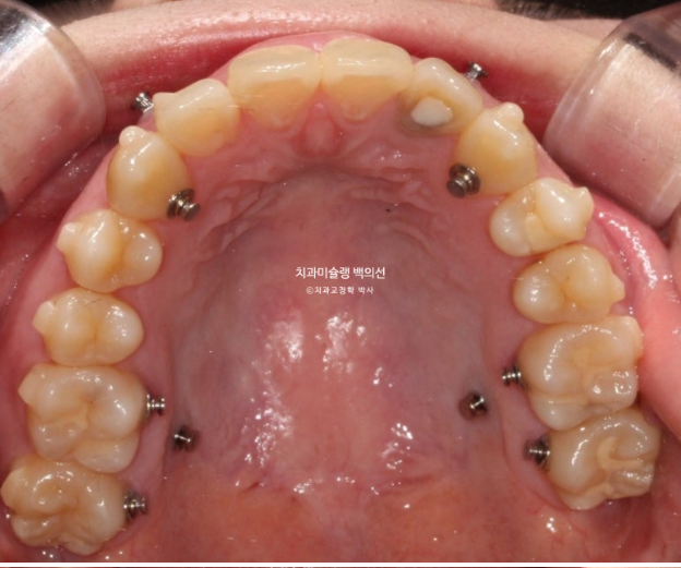 잇몸미소 인비절라인 거미스마일 토끼이빨 교정 무삭제 라미네이트 반대교합 치료 후기 관련 이미지 10