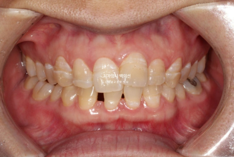 30대 교정 돌출입 교정 덧니 발치교정 치료기간 1년 8개월 관련 이미지 2