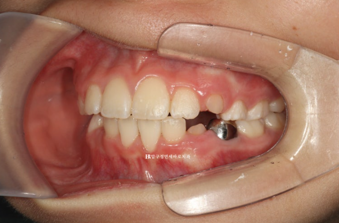 소아 투명교정 인비절라인 퍼스트 후기 기록 관련 이미지 10