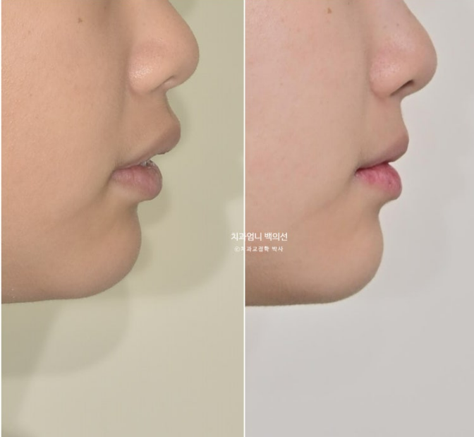 입이 안 다물어짐 입술부전증 호두턱 교정? 관련 이미지 16