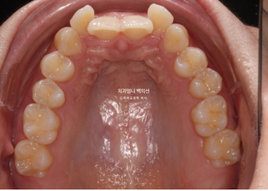 Inward-Tilted Teeth Orthodontic Treatment Review | A Real Case of Treating Congenitally Missing Lower Incisor (Three Lower Front Teeth) Without Extractions image 4