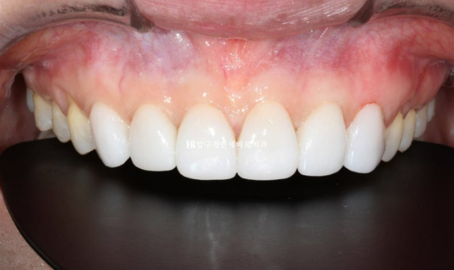 벌어진 치아 교정 인비절라인 라이트 무삭제 라미네이트 치료 관련 이미지 17