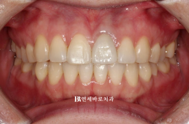 앞니가 부러져 임플란트 해야 한다고 들었는데, 교정으로 살릴 수 있을까요?|보철교정 실제 사례 관련 이미지 5