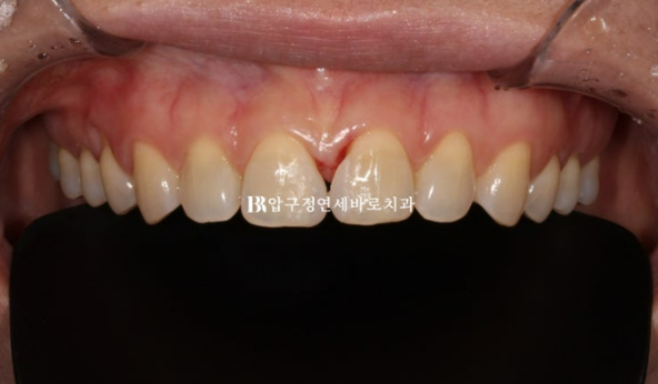 Can Gaps Between the Front Teeth Be Treated with No-Prep Veneers Alone? A Real Case Completed with Gelami After Invisalign Lite image 7
