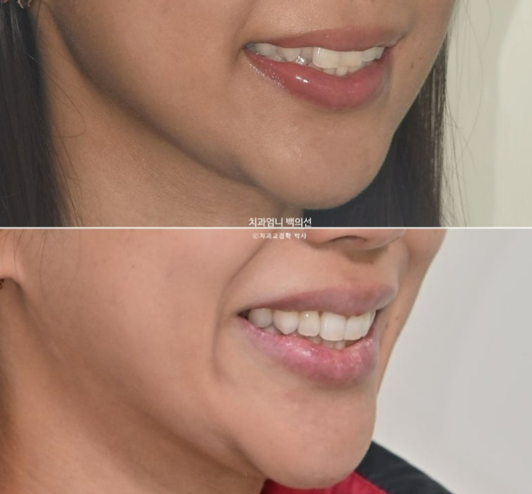 인비절라인 비발치 덧니 교정 반대교합 치료 후기 관련 이미지 20