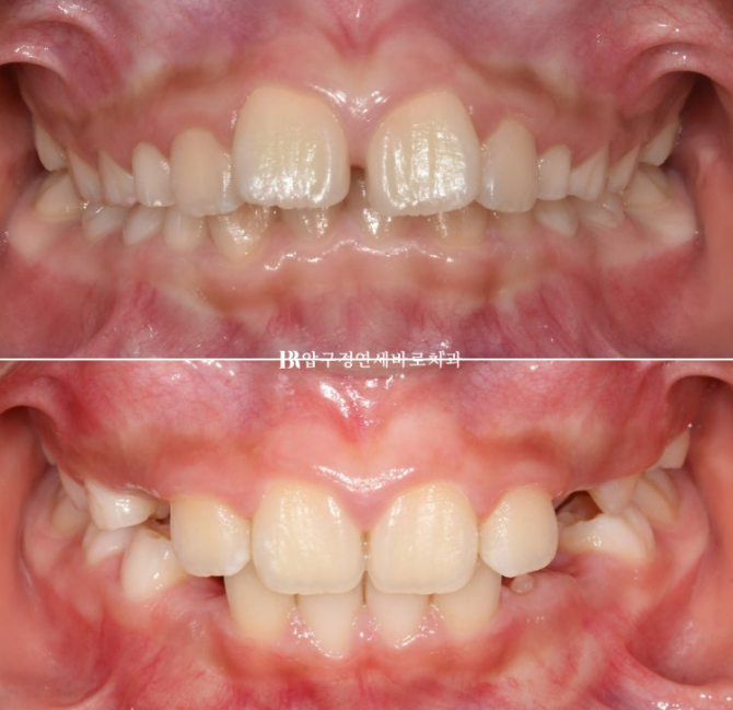 무턱교정 어린이 투명교정 인비절라인 퍼스트 교정 후기 관련 이미지 21