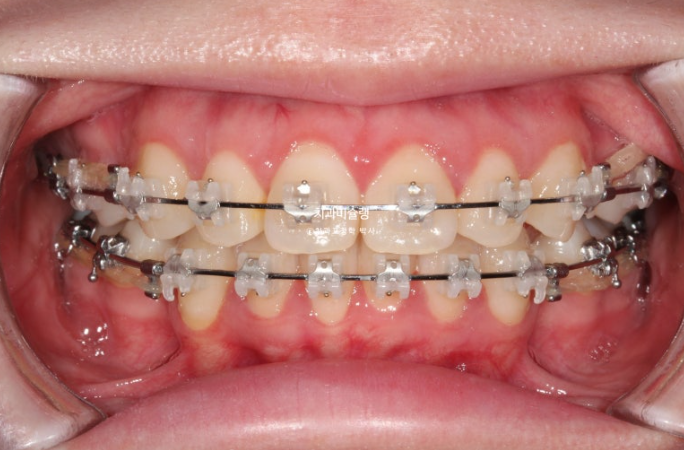 심한 돌출입 입술부전증 호두주름 발치교정 치료 관련 이미지 7