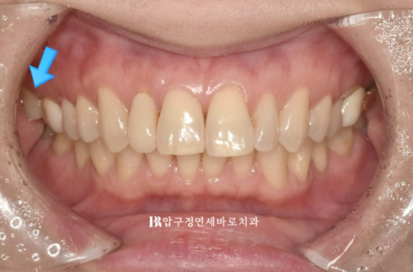 40대 발치교정 대신 인비절라인 라이트? 10개월 치료로 어디까지 가능할까요? 관련 이미지 3