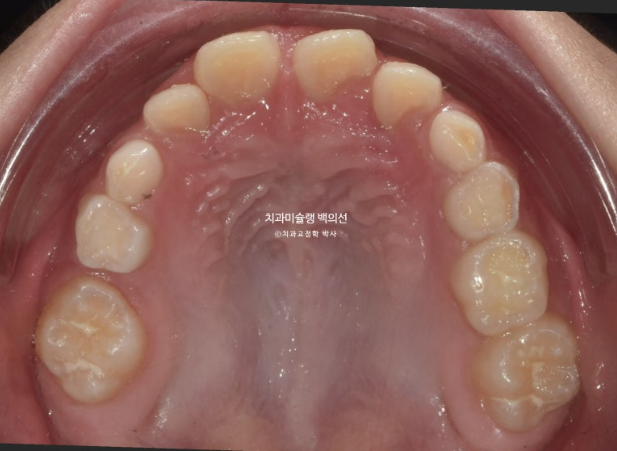 어린이 비대칭 반대교합 주걱턱 인비절라인 퍼스트 프리올소 성장 교정 관련 이미지 10
