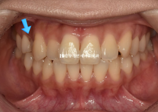 9-Month Invisalign Lite Review|Real Case Improving a Crossbite and Crooked Teeth Together image 2