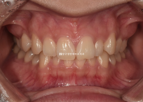 앞니 부분교정은 어떤 경우에 가능한가요? 단기 앞니 부분교정 왜소치 치료 무삭제 라미네이트 관련 이미지 2