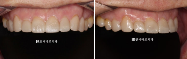 60대 무삭제 라미네이트 앞니 부분교정 치료 관련 이미지 6