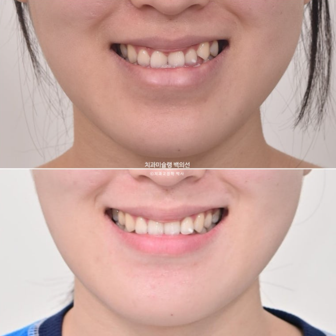 비수술 주걱턱 비대칭 발치 교정 결손치 반대교합 클리피씨 치료기간 1년 11개월 관련 이미지 16