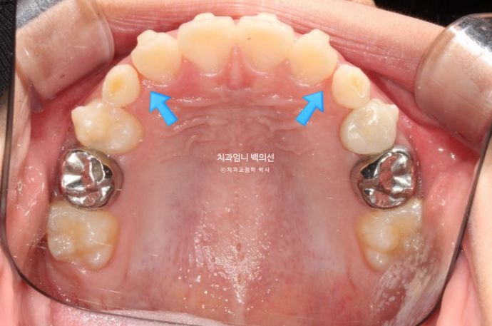 어린이 교정 인비절라인 퍼스트 비대칭 반대교합 어린이 성장 교정 관련 이미지 15