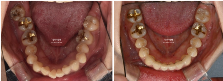 비발치 돌출입 인비절라인 교정 가위교합 중심선 맞추기 관련 이미지 21