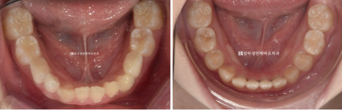 어린이교정 투명교정 인비절라인 퍼스트 후기 관련 이미지 5