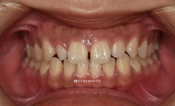 왜소치 인비절라인 라이트 교정 / 무삭제 라미네이트 젤라미 관련 이미지 1