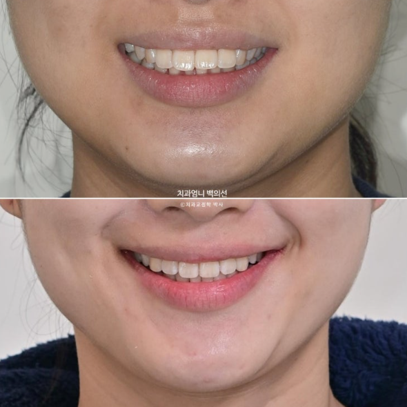 돌출입 교정 인비절라인 발치 교정 후기 관련 이미지 23