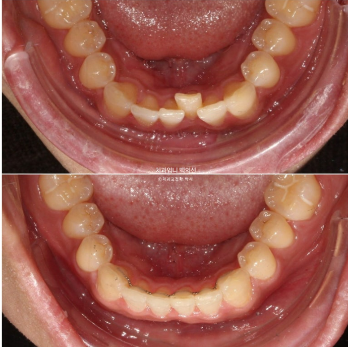 앞니 부분교정 덧니 교정 블랙트라이앵글 부정교합 마모 시뮬레이션 치료기간 5개월 관련 이미지 17