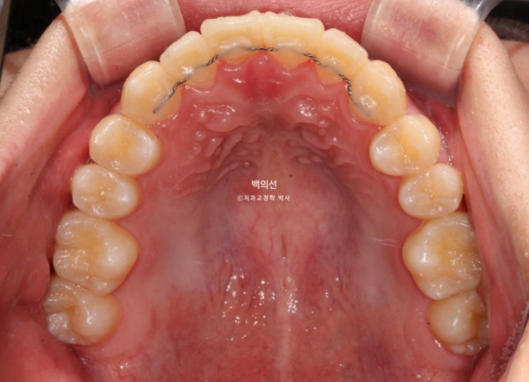유학생 교정 덧니 반대교합 인비절라인 라이트 치료기간 관련 이미지 13