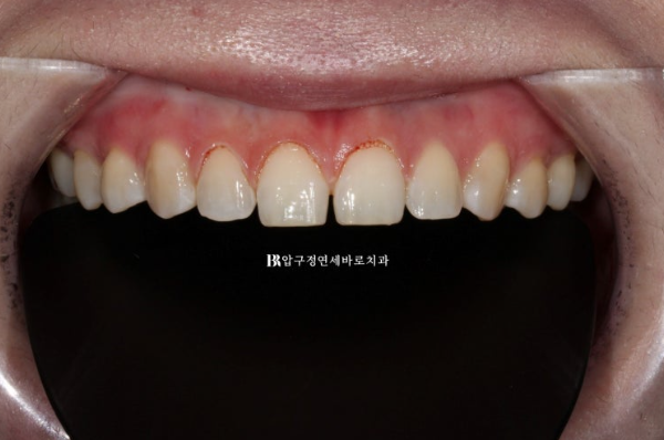 If Your Front Teeth Look Spaced Due to Peg-Shaped Teeth or Microdontia: A Case Choosing No-Prep Veneers Instead of Orthodontic Treatment image 4