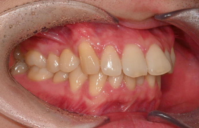 인비절라인 라이트 돌출 과개교합 중심선 교정 치간삭제 치료기간 관련 이미지 3