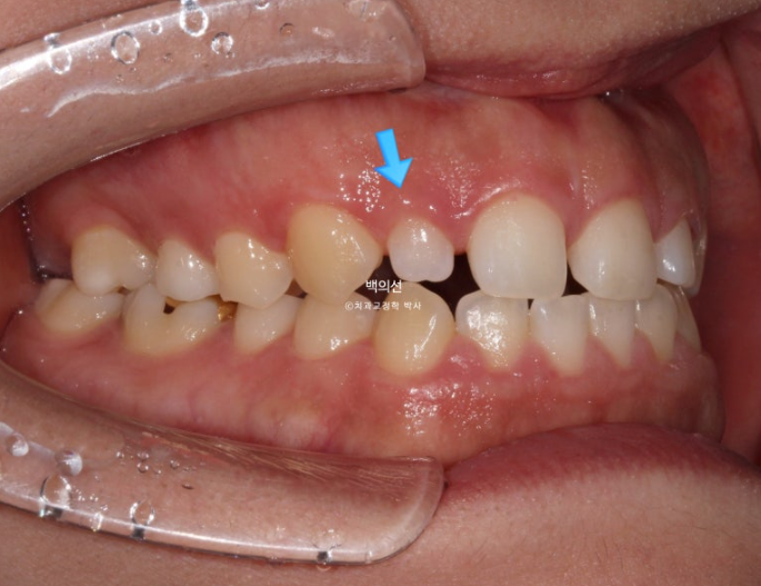 30대 치아교정 돌출입 교정 :: 잇몸미소 거미스마일 교정 입술부전증 결손치 무턱교정 관련 이미지 4