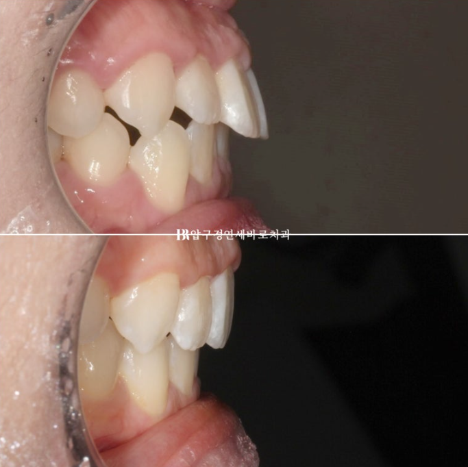 인비절라인 라이트 과개교합 반대교합 돌출입 뻐드렁니 교정 치료 관련 이미지 14