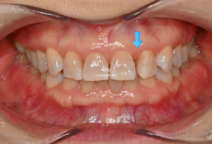 50대 치아교정 :: 인비절라인 익스프레스 치아 벌어짐 단기교정 후기 관련 이미지 7