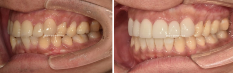 40대 치아교정 인비절라인 라이트 덧니 교정 어금니 교합 부작용 관련 이미지 14