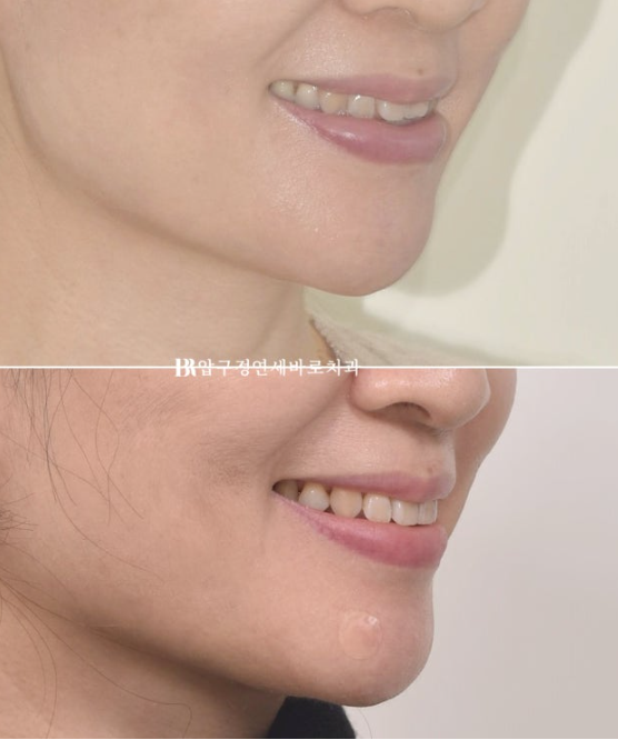 Orthodontics in Your 40s: Worried Your Gums Will Recede? | A 6-Month Front Teeth Partial Orthodontic Case That Also Improved Black Triangles image 11