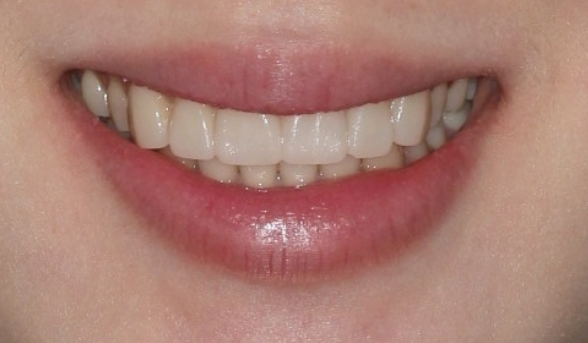 How to Create a Beautiful Smile Line? | A Real Case of Changing a Smile with No-Prep Laminates image 8