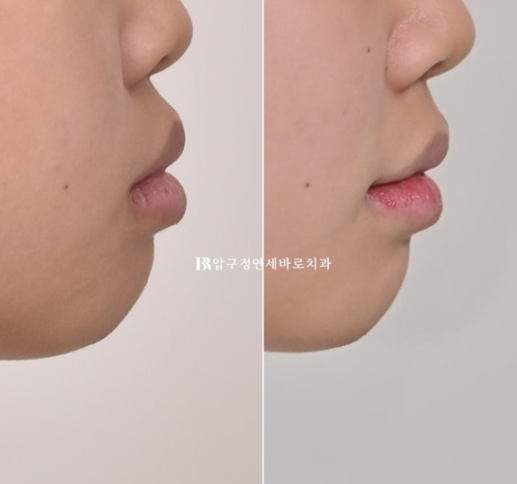 강남 소아교정 인비절라인 퍼스트 어린이 반대교합 관련 이미지 18