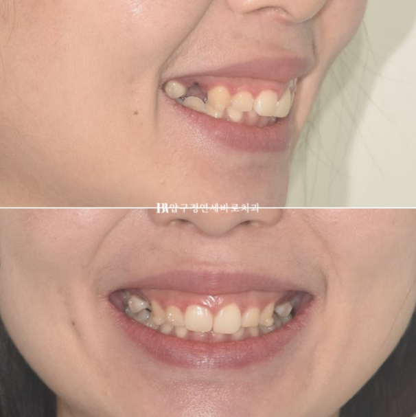 Can't Invisalign Move the Roots? An Actual Case of Extraction Treatment for Protruding Mouth at a Gangnam Orthodontic Clinic image 3