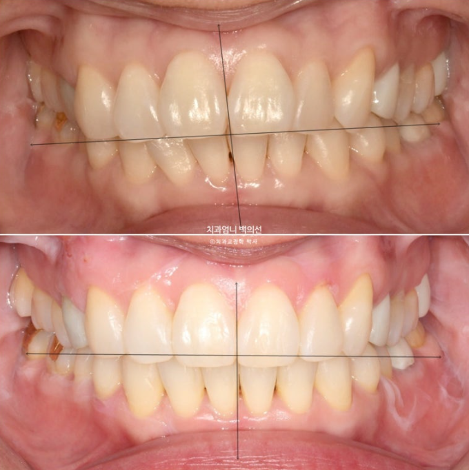 50대 캔팅 교합평면 기울어짐 덧니 교정 인비절라인 라이트 교정? 관련 이미지 13