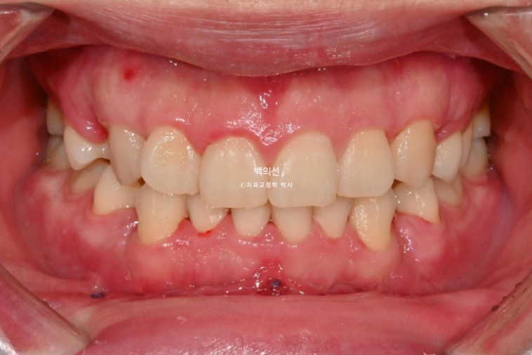 돌출입 수술 ASO + 인비절라인 라이트 후교정 치료기간 10개월 관련 이미지 2