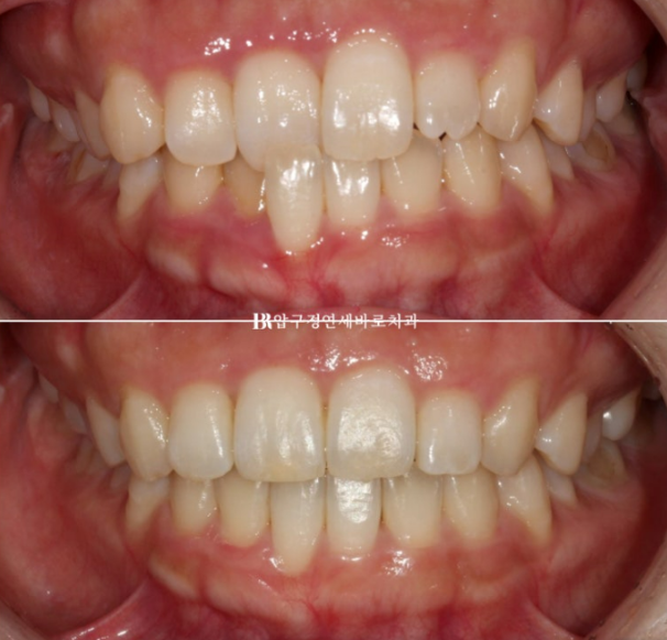 앞니부분교정 기간? MTA 미니튜브 교정 반대교합 교정 관련 이미지 11