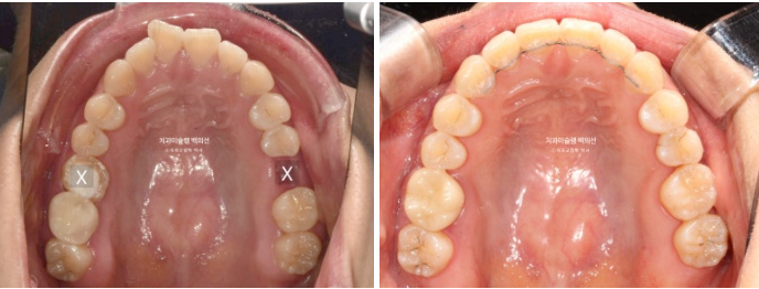 인비절라인 돌출입 발치교정 임플란트 없이 사랑니 대체 관련 이미지 20