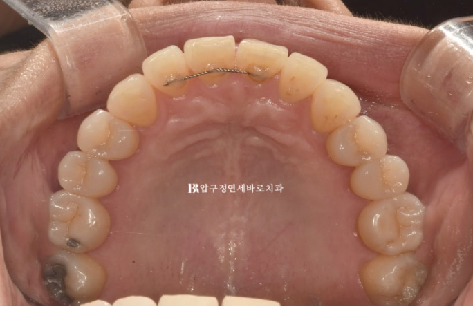 How to Avoid Regretting No-Prep Laminate Veneers: The Fitting Process Revealed image 2