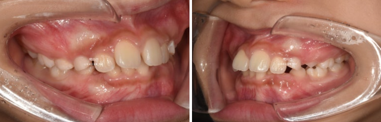인비절라인퍼스트 어린이 투명교정 과개교합 덧니 악궁확장 돌출 관련 이미지 3