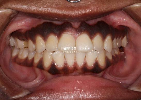 Extraction & re-orthodontics with Clippy-C, intrusion for dental implant. 관련 이미지 2