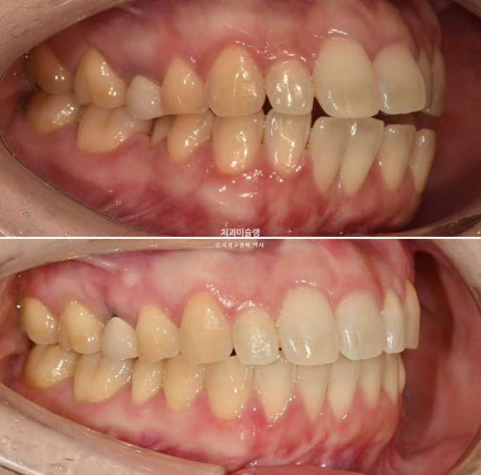 비발치 인비절라인 교정 편측 개방교합 가위교합 돌출 재교정 관련 이미지 21