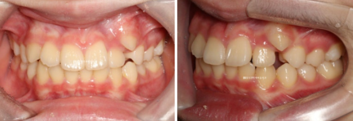 덧니 인비절라인 교정 :: 강남 인비절라인 교정치과 관련 이미지 1