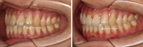인비절라인 익스프레스 토끼이빨 교정 기간? 인비절라인 종류는? 관련 이미지 12