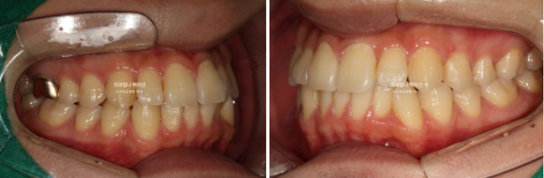 인비절라인 비발치 앞니 돌출 교정 치료기간 2년 5개월 관련 이미지 3