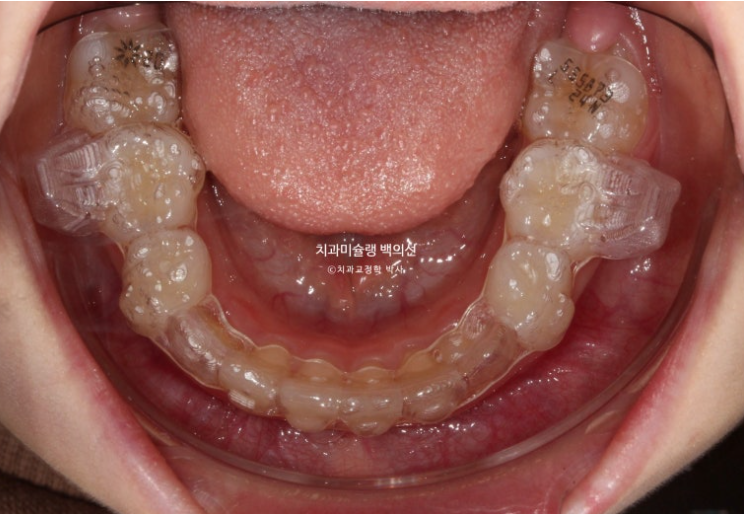 어린이 무턱 성장교정 덧니 인비절라인 퍼스트 악궁확장 치료기간 2년 관련 이미지 16