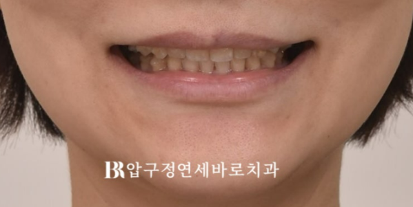 임플란트가 있어도 교정이 가능할까요? 캔팅 재교정 실제 사례 관련 이미지 5