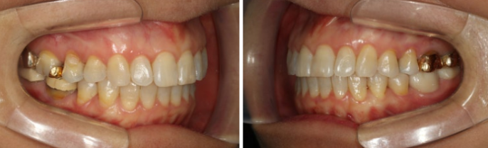 40대 후반 치아교정 해도 될까요? 관련 이미지 4