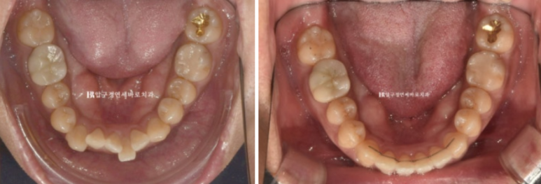 40대 치아교정 인비절라인 라이트 덧니 교정 어금니 교합 부작용 관련 이미지 15